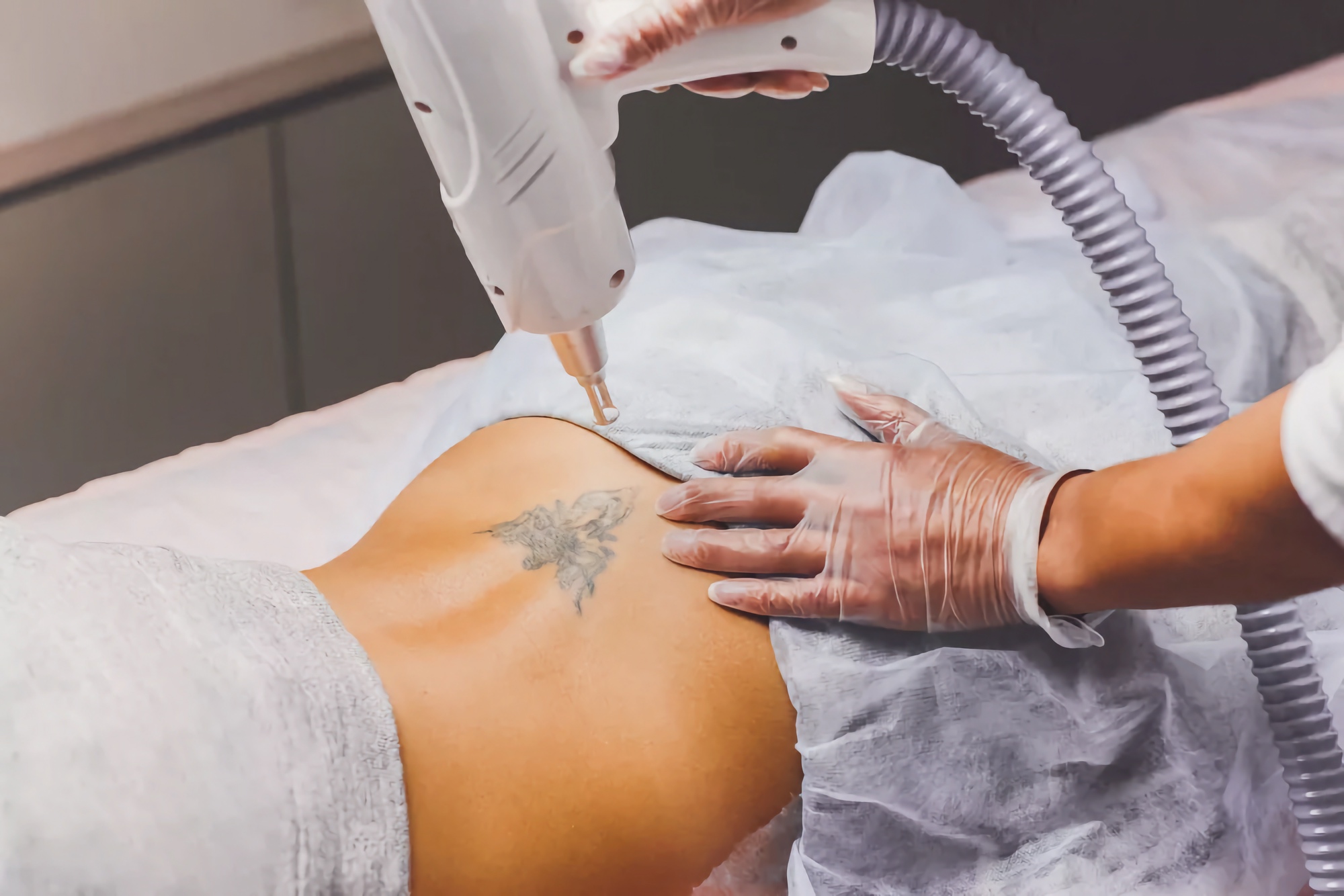 Laser Tattoo Removal