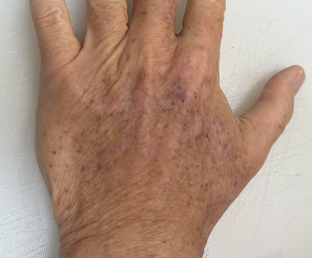 Laser Skin Rejuvenation after 1 treatment