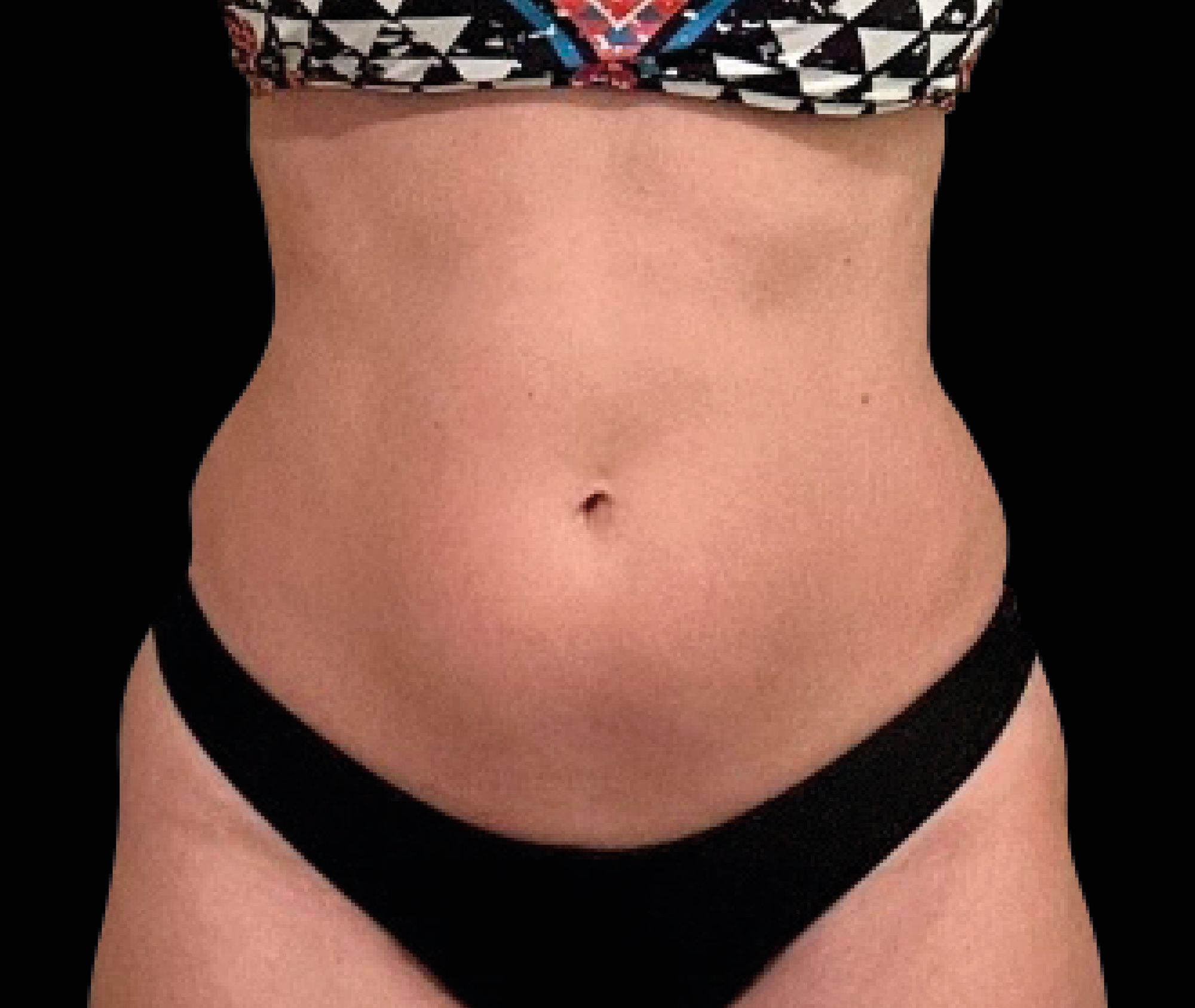 emsculpt neo before